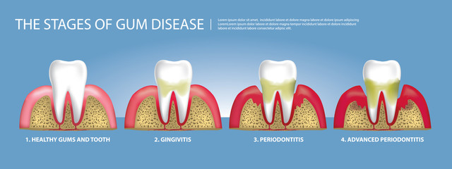 Fototapeta premium Human teeth Stages of Gum Disease Vector Illustration