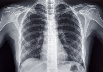 Chest x-ray of an adult female human - obrazy, fototapety, plakaty