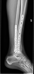 Radiografia caviglia, rottura tibia e perone