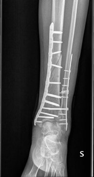 Radiografia caviglia, rottura tibia e perone