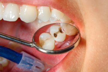 Dental caries. Filling with dental composite photopolymer material using rabbders. Concept of dental treatment in dental clinic