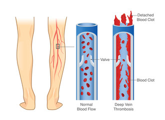 Medical Diagram of Deep Vein Thrombosis at leg area. Illustration about abnormally of blood floow.