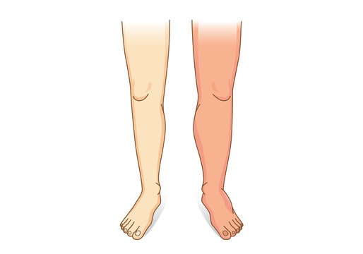 Human Leg swelling in front view. Illustration about the diseases and conditions of fluid gathers in foot and leg.