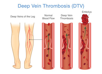 Medical Diagram of Deep Vein Thrombosis at leg area. Illustration about abnormally of blood floow. - obrazy, fototapety, plakaty