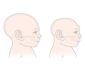 Comparative anatomical image of the head and skull of a newborn child with a normal cranium and with microcephaly. The virus of Zika.  Isolated on white background