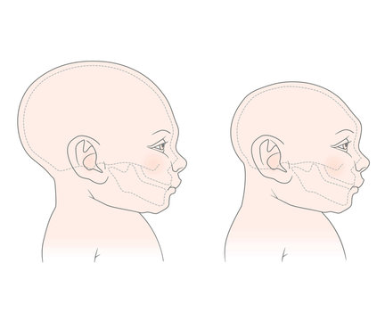 Comparative anatomical image of the head and skull of a newborn child with a normal cranium and with microcephaly. The virus of Zika.  Isolated on white background