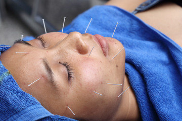 Close up Hand Perform Medical of professional acupuncture treatment