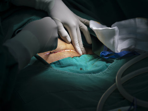 Surgeon or doctor and assistants hands wearing surgical sterile gloves doing surgical procedure or operation with skin incision under high key light tone of surgical lamp