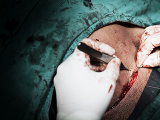 Surgeon hands wearing sterile surgical gloves and doing surgical operation or procedure surgical incision skin closure by sewing needle after cesarean section birth