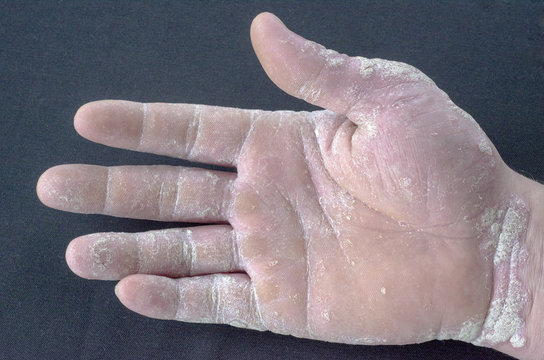 exacerbation of psoriasis on the hands on a gray background