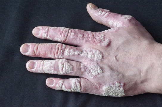 exacerbation of psoriasis on the hands on a gray background