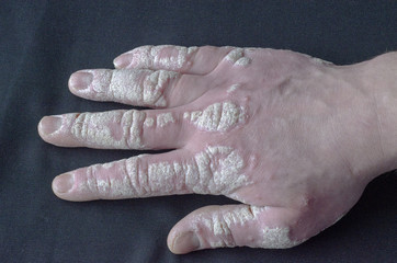 Exacerbation of psoriasis scaly, eczema on the arm.