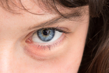 Puffy eye of woman looking from below