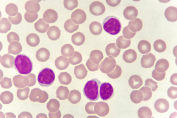Leukemia cells in blood smear, analyze by microscope
