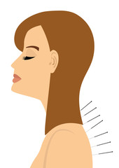 Young woman getting an acupuncture therapy with needles in back