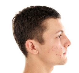 Obraz premium Young man with acne problem on white background