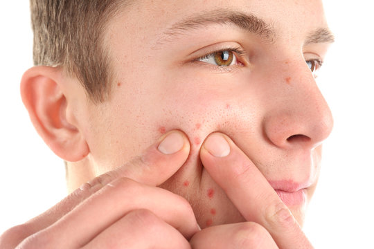 Young man squeezing acne on white background