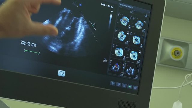 dettagli del cuore visti sul monitor di un pc in un reparto di cardio chirurgia