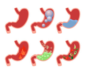 Vector illustration cartoon set medical illustrations of Abdominal bloated stomach. Different types of stomach sickness. Gas, alcohol, swelling, heartburn, food and water inside stomach.