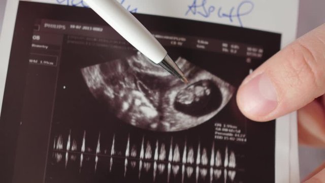 doctor showing embryo, child on printout of ultrasound examination