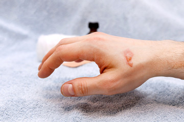 Burn blister on the hand in the hospital