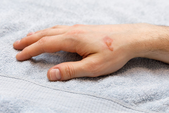 Burn blister on the hand in the hospital