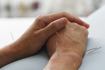 acupuncture - 197583570