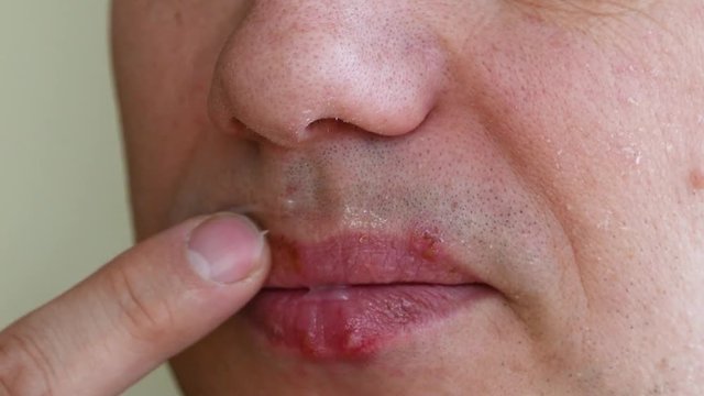 herpes simplex virus infection. Lips treatment by cream. Male face. slow motion