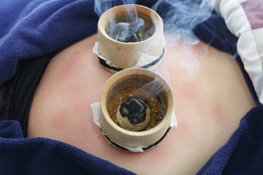 Moxibustion