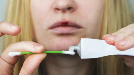 A woman puts on the lips ointment from herpes
