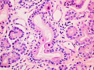 Cytomegalovirus CMV infection in the salivary gland viewed at 400x magnification with haemotoxylin...