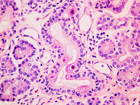 Cytomegalovirus CMV infection in the salivary gland viewed at 400x magnification with haemotoxylin and eosin staining