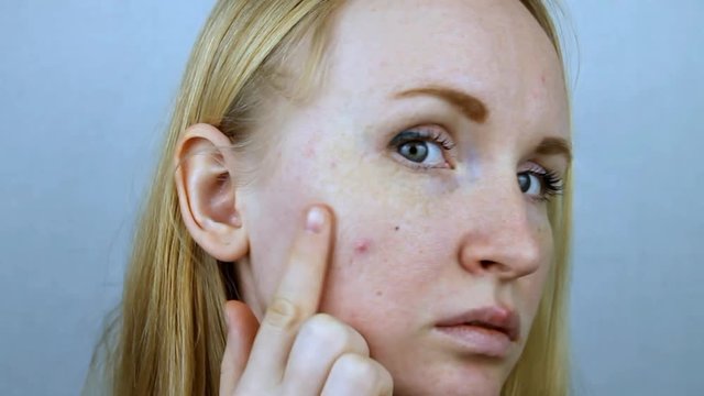 A young beautiful blonde looks at the cheek on which the pimple appeared.