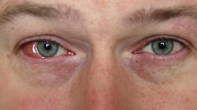 Man showing eyes conjunctivitis.
