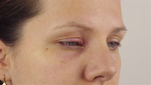 Young woman with hordeolum disease in the eye.