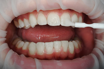  tooth fluoridation