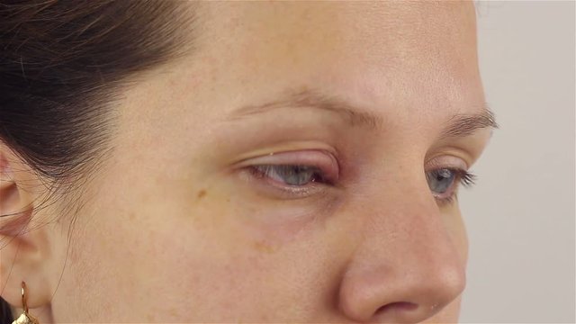 Young woman with hordeolum disease in the eye.