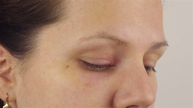 Young woman with hordeolum disease in the eye.