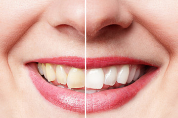 junge Frau vor und nach dem Zähne bleichen 