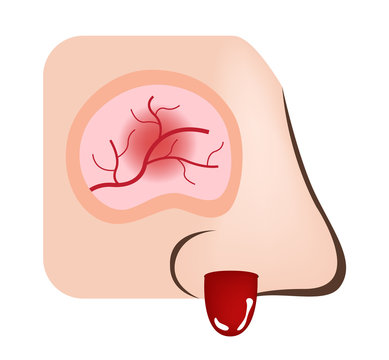 nose bleeding vector / inflamed nasal and sinus