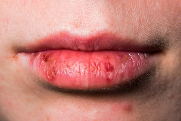 Fototapeta premium Damaged female lips close up
