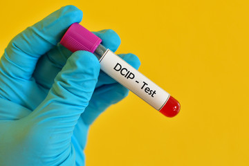 Fototapeta premium Test tube with blood sample for DCIP (dichlorophenol indophenol precipitation) test, thalassemia diagnosis