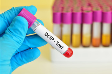 Obraz premium Test tube with blood sample for DCIP (dichlorophenol indophenol precipitation) test, thalassemia diagnosis