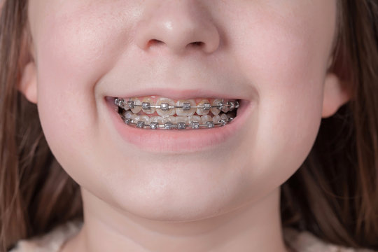 Broad smile girl with metal braces.