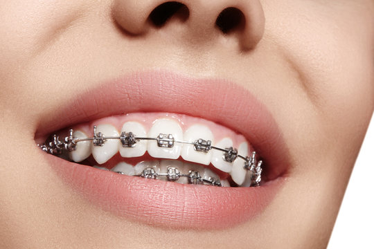 Beautiful white teeth with braces. Dental care photo. Woman smile with ortodontic accessories. Orthodontics treatment