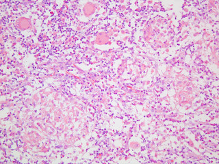 Crohns Disease granuloma in the small intestine viewed at 200x magnification with haemotoxylin and eosin staining