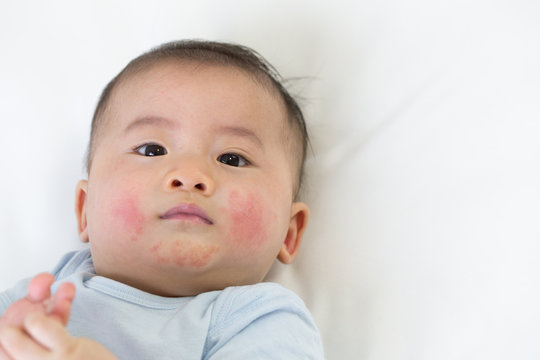 Skin rashes in babies concept