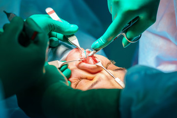 Plastic surgery of the nose in operating room, rhinoplasty