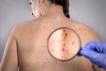 epidemic varicella viral infection concept. girls back skin bubble rash - obrazy, fototapety, plakaty