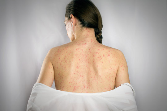treatment chickenpox viral infection concept. girls back skin rashes